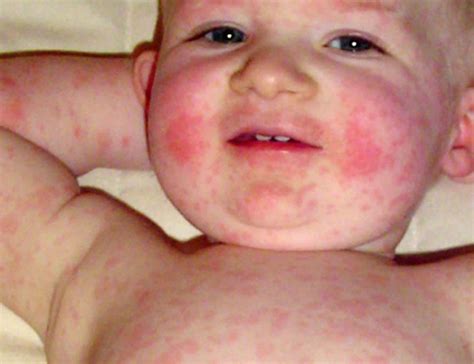 parvovirus b19 symptoms in child